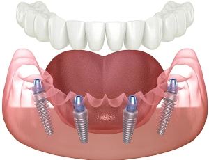 All in four Dental Implant
