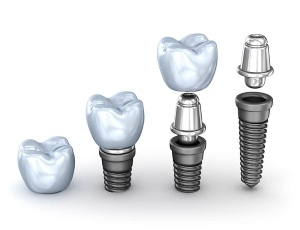 Dental Implant Cost Noida