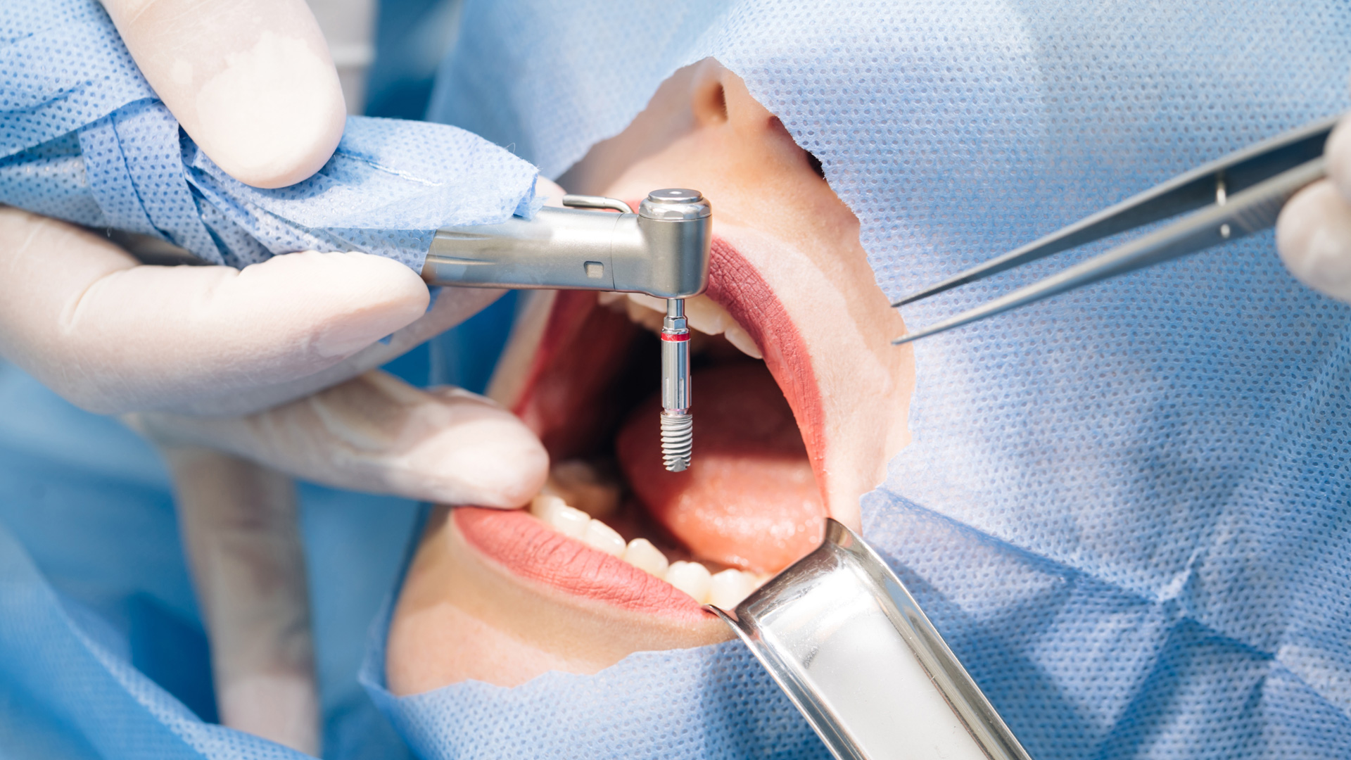 Best Dental Implants near Noida Authority Flats Sector 26